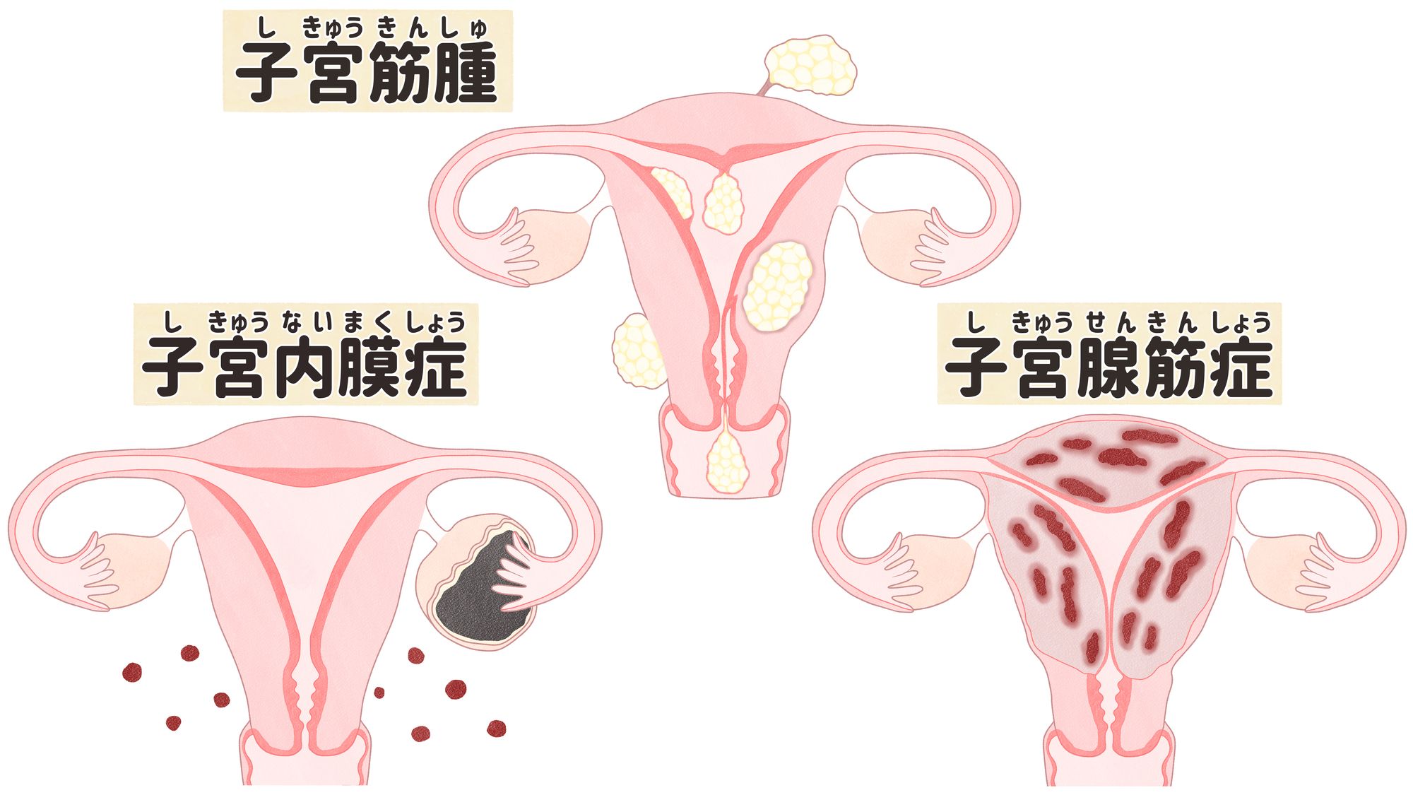 よく似た名前の子宮筋腫、子宮内膜症、子宮腺筋症の違い