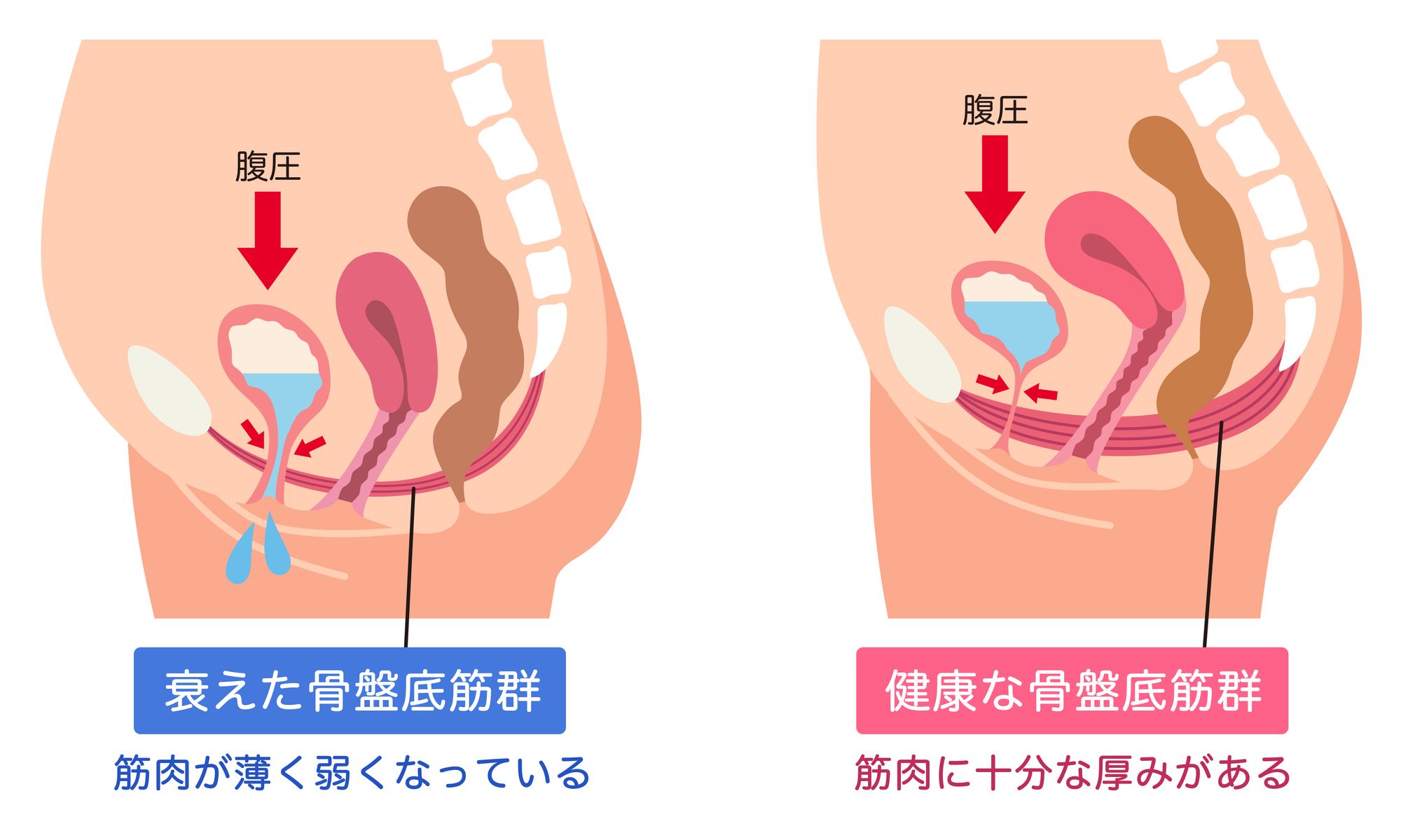 筋肉が弱くなった骨盤底筋群と十分に厚みがある骨盤底筋群の比較