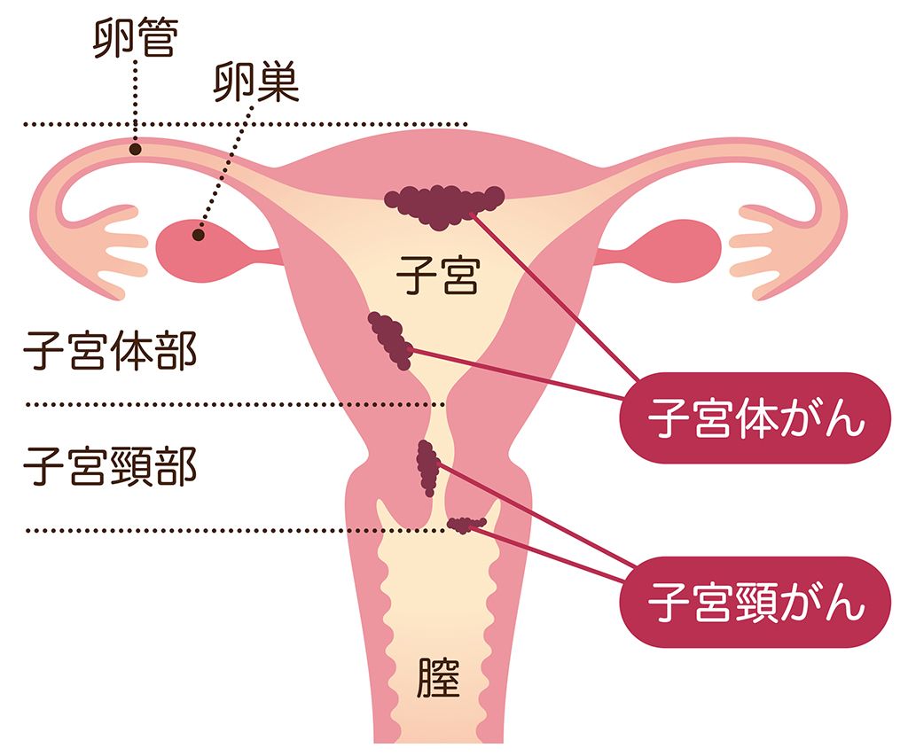 子宮　子宮体がん　子宮頸がん
