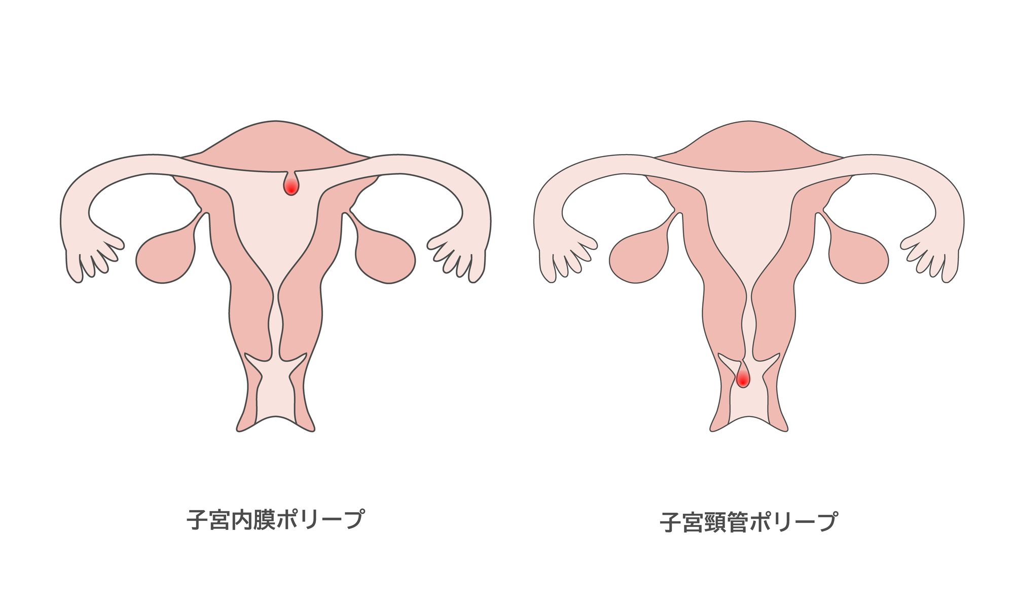 子宮頸管ポリープと子宮内膜ポリープのイラスト