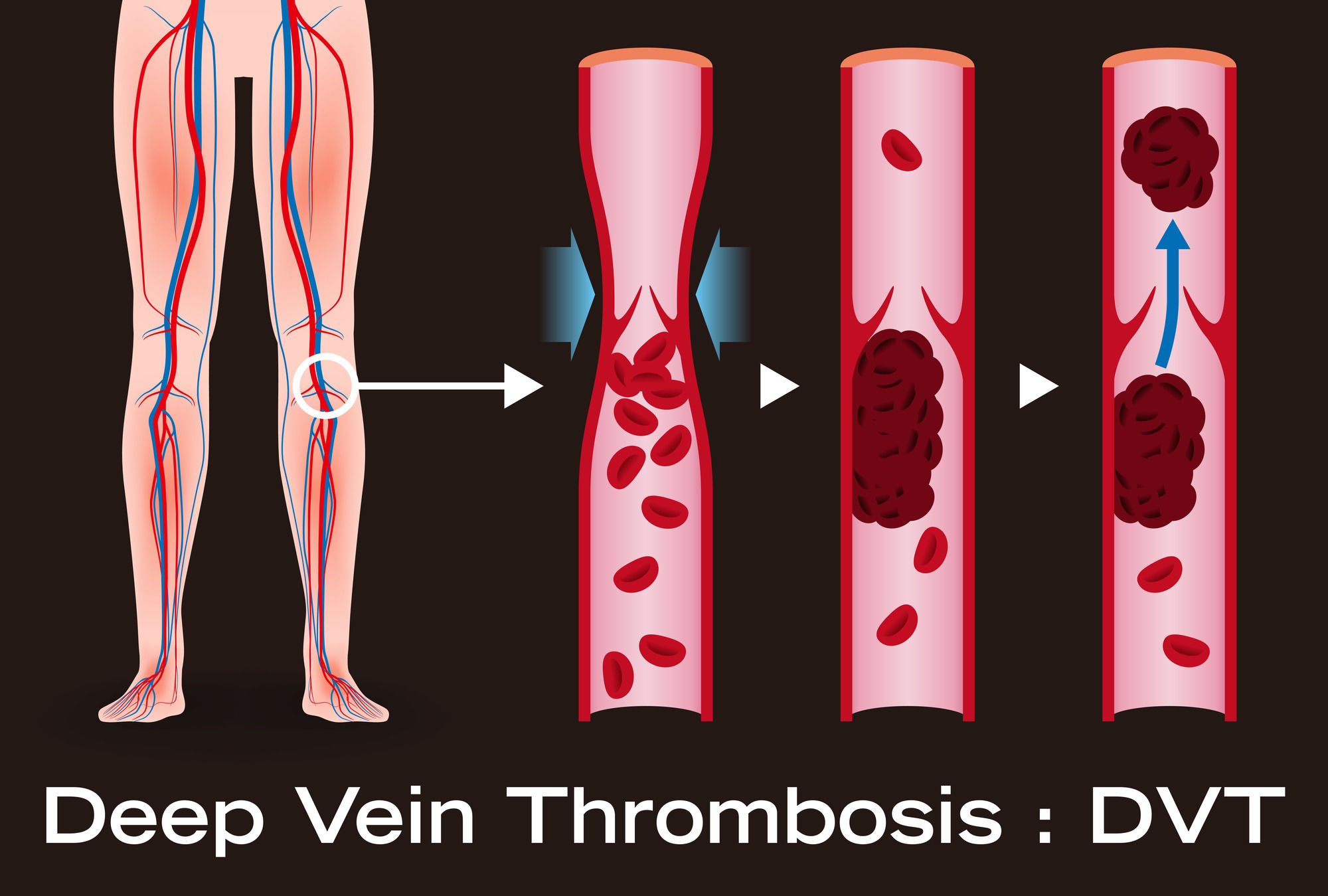 血栓症（DVT）の血管を説明したイラスト