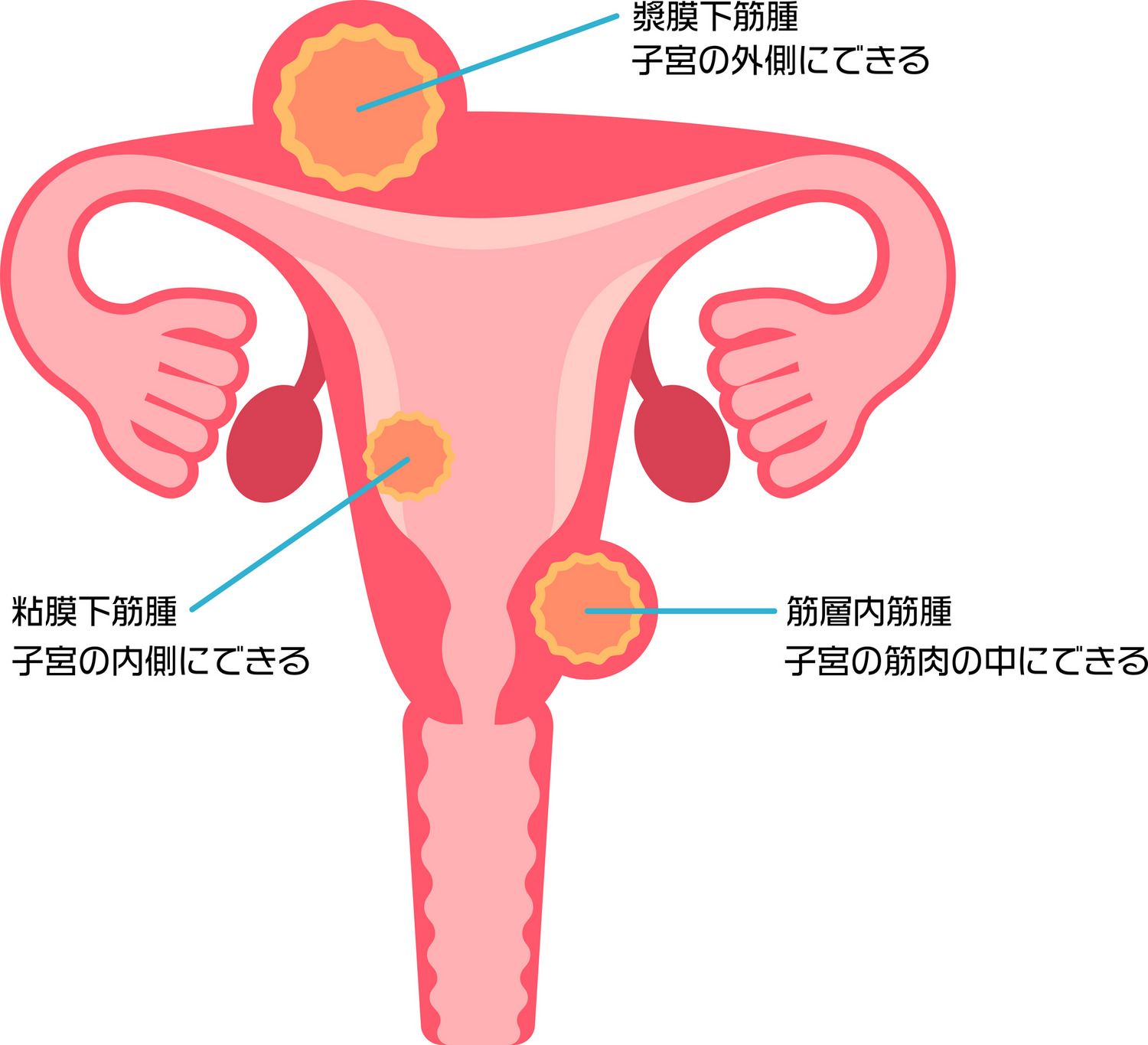 子宮筋腫 種類